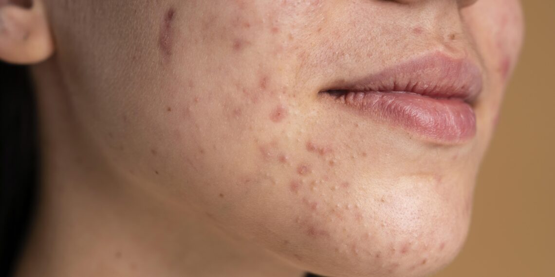 Jenis-jenis Jerawat dan Cara Mengatasinya