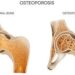 Mengenal Osteoporosis Imperfekta: Penyakit Langka Tiktoker Zehan Almira