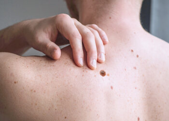 Mengenal Melanoma, Penyakit yang Mengakhiri Perjuangan Jimmy Carter