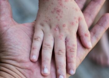 Salah Perawatan Bisa Parah, Ini Pantangan Campak